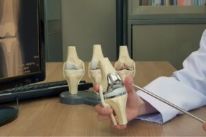 Knee Transplantation